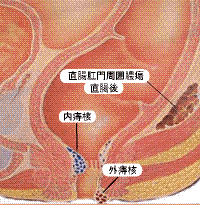 痔核の図画像