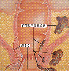 痔ろうの図画像